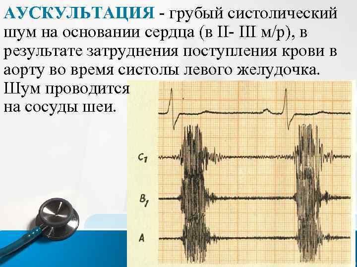 АУСКУЛЬТАЦИЯ - грубый систолический шум на основании сердца (в II- III м/р), в результате