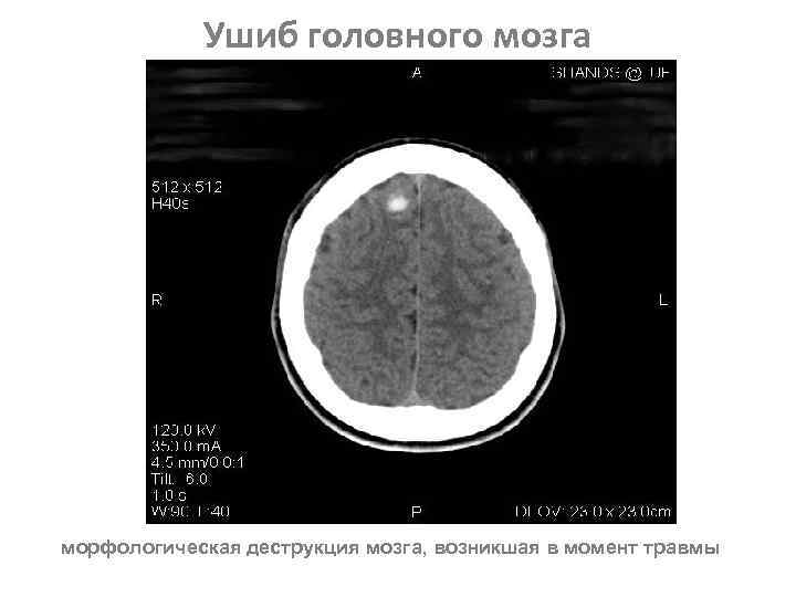 Ушиб головного мозга морфологическая деструкция мозга, возникшая в момент травмы 