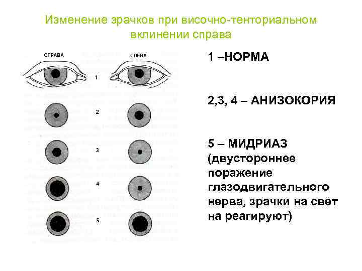 Изменение зрачков при височно-тенториальном вклинении справа 1 –НОРМА 2, 3, 4 – АНИЗОКОРИЯ 5