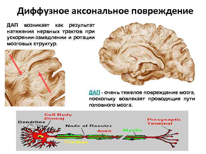 Диффузное аксональное повреждение ДАП возникает как результат натяжения нервных трактов при ускорении-замедлении и ротации