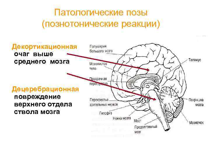 Патологические позы (познотонические реакции) Декортикационная очаг выше среднего мозга Децеребрационная повреждение верхнего отдела ствола