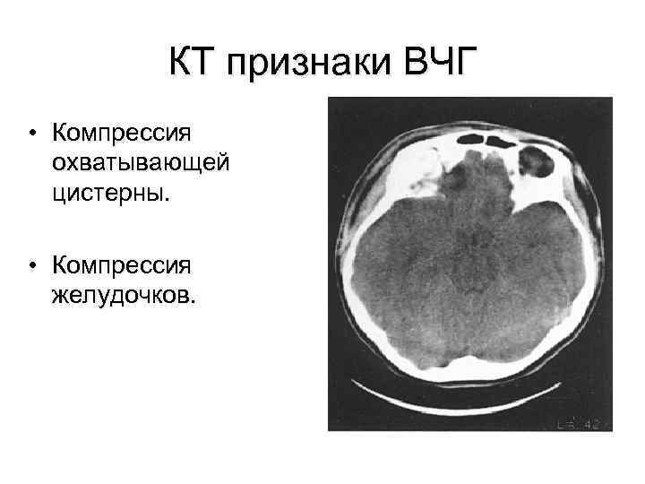 КТ признаки ВЧГ • Компрессия охватывающей цистерны. • Компрессия желудочков. 