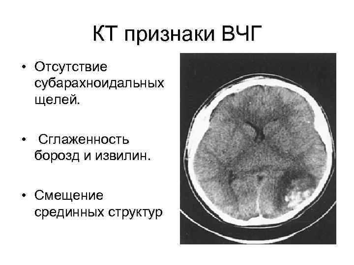 КТ признаки ВЧГ • Отсутствие субарахноидальных щелей. • Сглаженность борозд и извилин. • Смещение