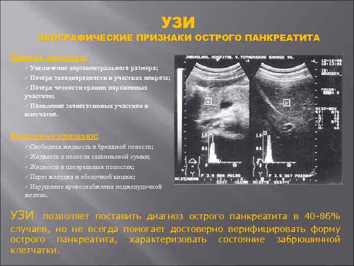 УЗИ ЭХОГРАФИЧЕСКИЕ ПРИЗНАКИ ОСТРОГО ПАНКРЕАТИТА Прямые признаки: Увеличение дорзовентрального размера; ü Потеря эхооднородности в