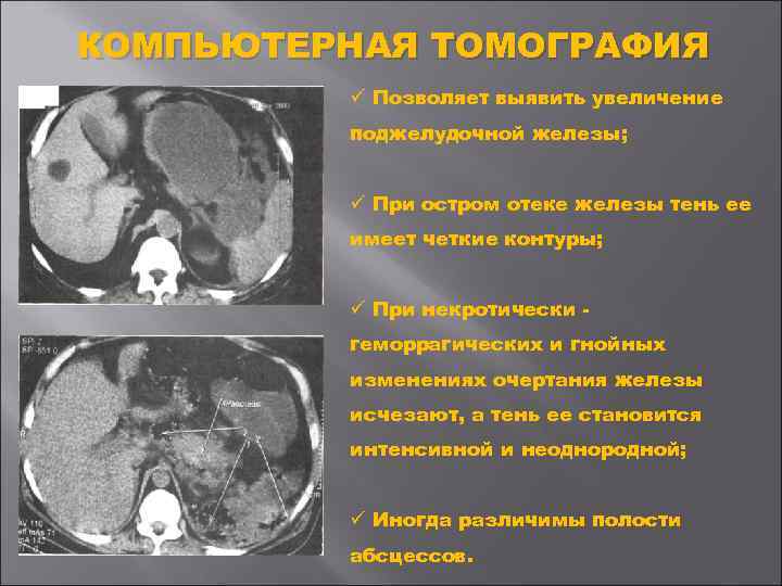 КОМПЬЮТЕРНАЯ ТОМОГРАФИЯ ü Позволяет выявить увеличение поджелудочной железы; ü При остром отеке железы тень