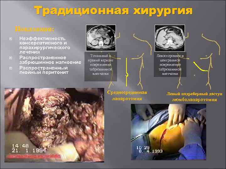 Традиционная хирургия Показания: Неэффективность консервативного и парахирургического лечения Распространенное забрюшинное нагноение Распространенный гнойный перитонит