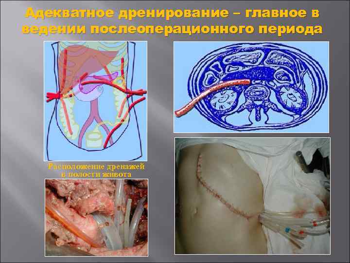 Адекватное дренирование – главное в ведении послеоперационного периода Расположение дренажей в полости живота 