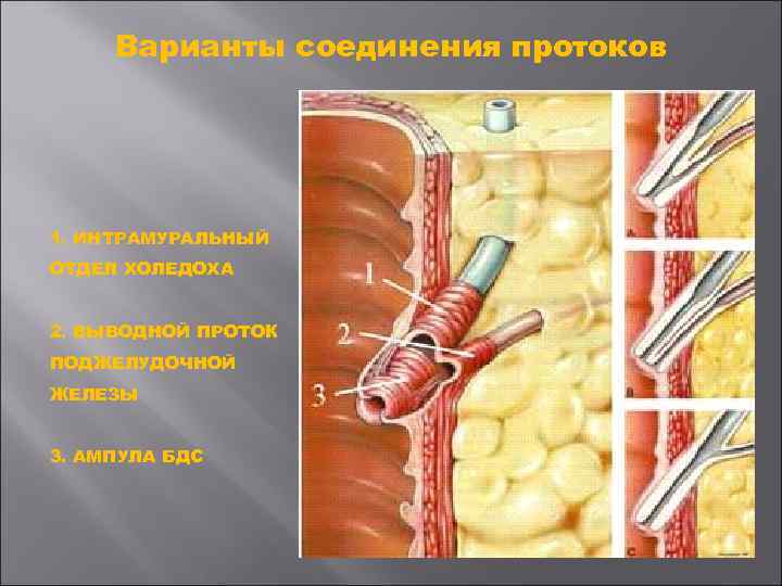 Варианты соединения протоков 1. ИНТРАМУРАЛЬНЫЙ ОТДЕЛ ХОЛЕДОХА 2. ВЫВОДНОЙ ПРОТОК ПОДЖЕЛУДОЧНОЙ ЖЕЛЕЗЫ 3. АМПУЛА