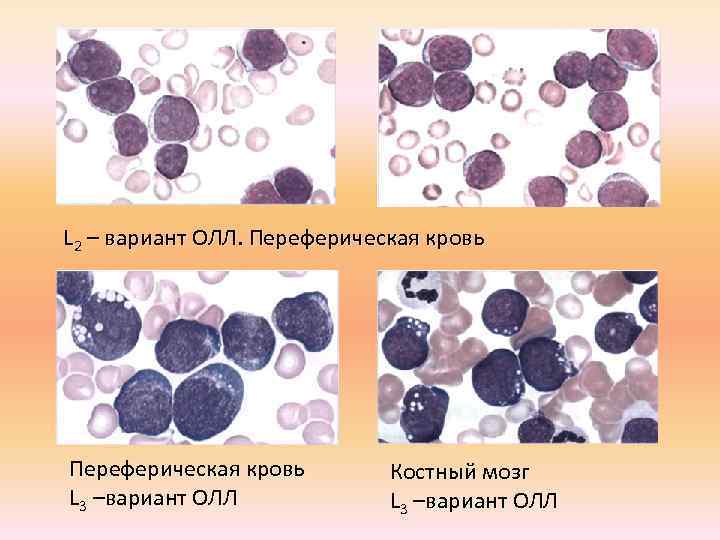 L 2 – вариант ОЛЛ. Переферическая кровь L 3 –вариант ОЛЛ Костный мозг L