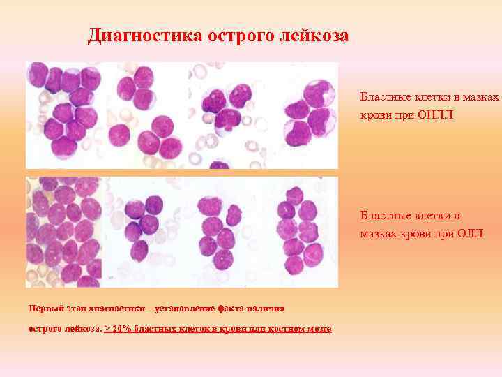 Диагностика острого лейкоза Бластные клетки в мазках крови при ОНЛЛ Бластные клетки в мазках