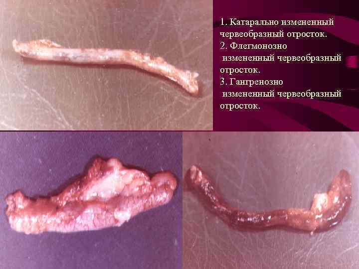 1. Катарально измененный червеобразный отросток. 2. Флегмонозно измененный червеобразный отросток. 3. Гангренозно измененный червеобразный