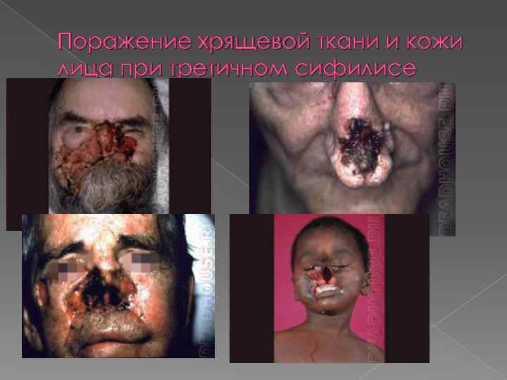 Поражение хрящевой ткани и кожи лица при третичном сифилисе 