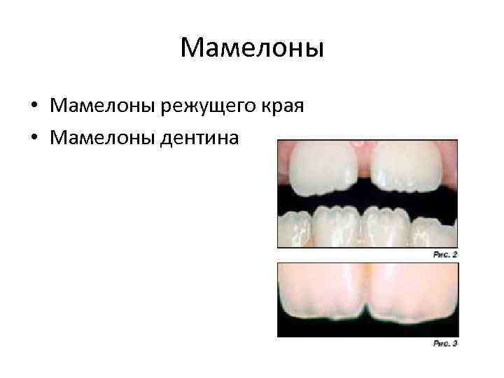 Мамелоны • Мамелоны режущего края • Мамелоны дентина 