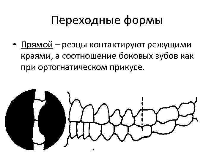 Переходные формы • Прямой – резцы контактируют режущими краями, а соотношение боковых зубов как