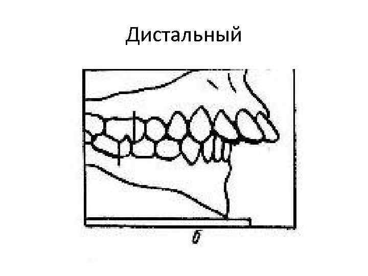 Дистальный 