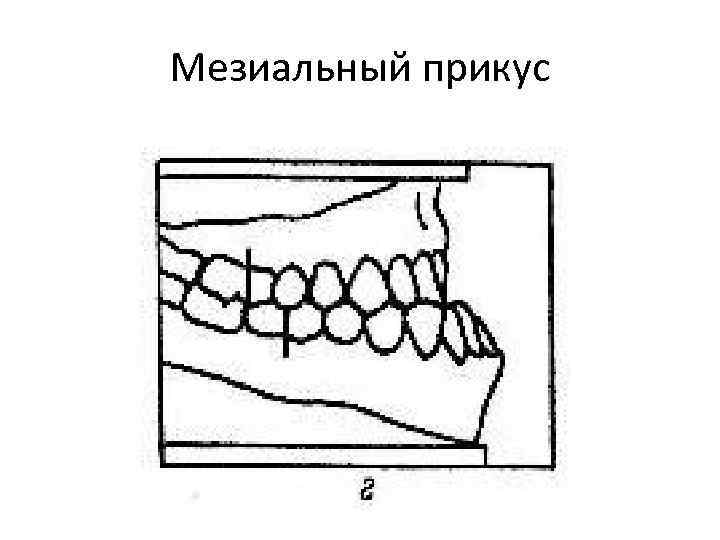 Мезиальный прикус 