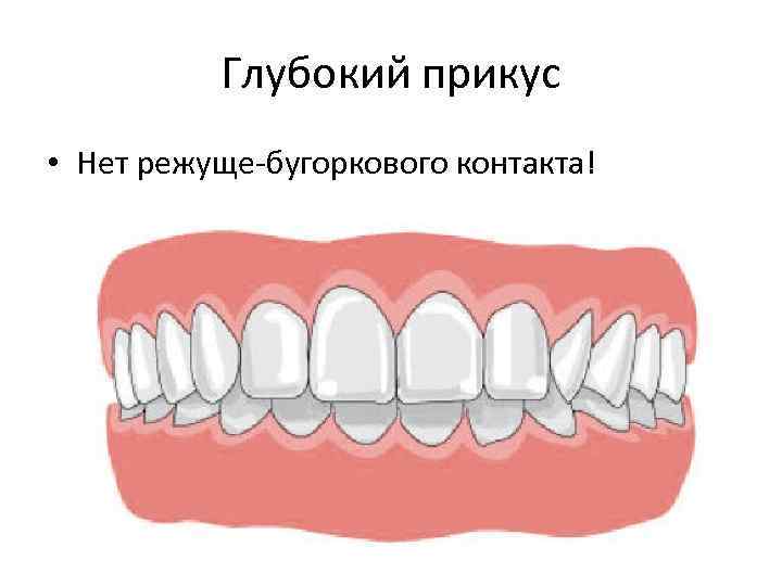 Глубокий прикус • Нет режуще-бугоркового контакта! 