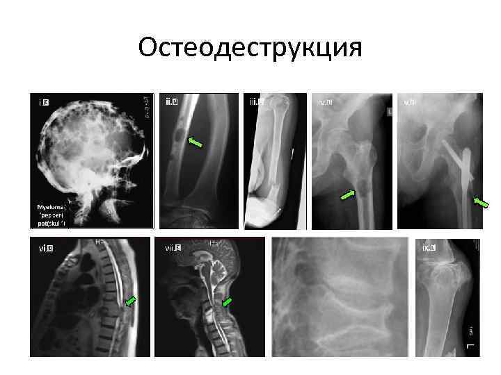 Множественная миелома фото больных