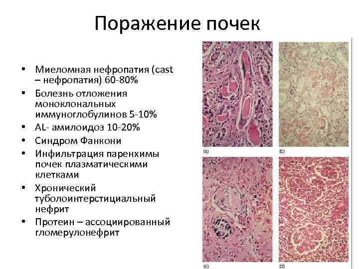 Поражение почек • Миеломная нефропатия (cast – нефропатия) 60 -80% • Болезнь отложения моноклональных