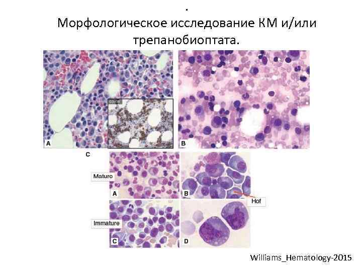 . Морфологическое исследование КМ и/или трепанобиоптата. Williams_Hematology-2015 