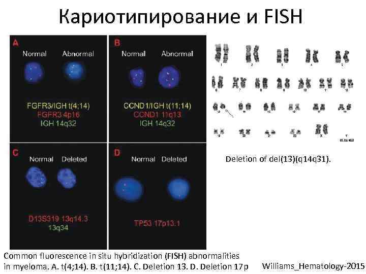 Кариотипирование и FISH Deletion of del(13)(q 14 q 31). Common fluorescence in situ hybridization