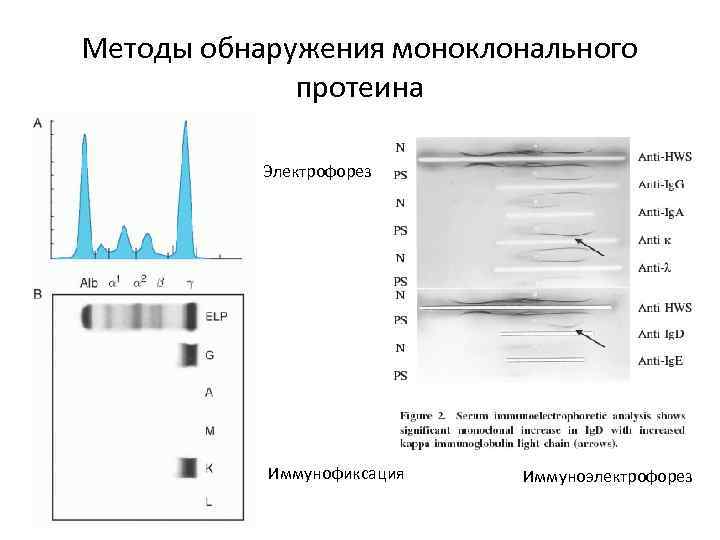 Методы обнаружения моноклонального протеина Электрофорез Иммунофиксация Иммуноэлектрофорез 