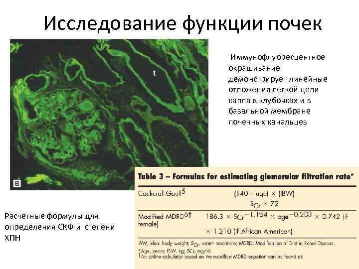 Исследование функции почек Иммунофлуоресцентное окрашивание демонстрирует линейные отложения легкой цепи каппа в клубочках и