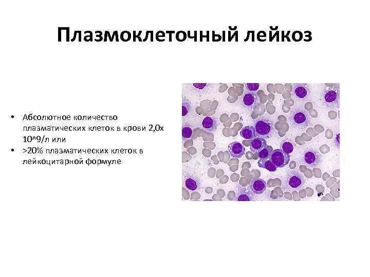 Плазмоклеточный лейкоз • Абсолютное количество плазматических клеток в крови 2, 0 х 10^9/л или