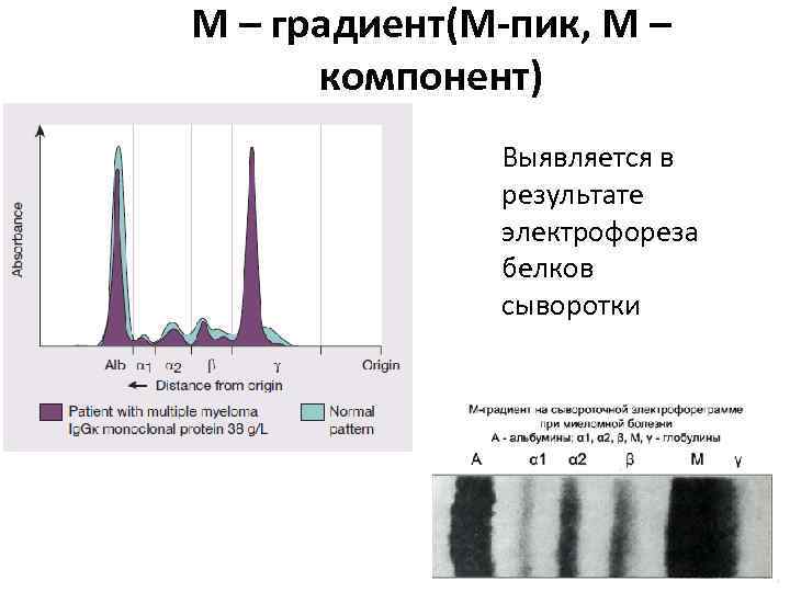 М – градиент(М-пик, М – компонент) Выявляется в результате электрофореза белков сыворотки 