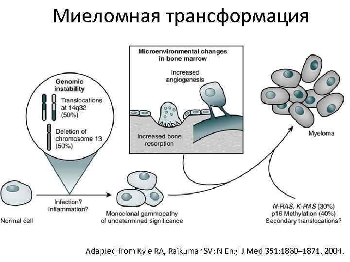 Миеломная трансформация Adapted from Kyle RA, Rajkumar SV: N Engl J Med 351: 1860–