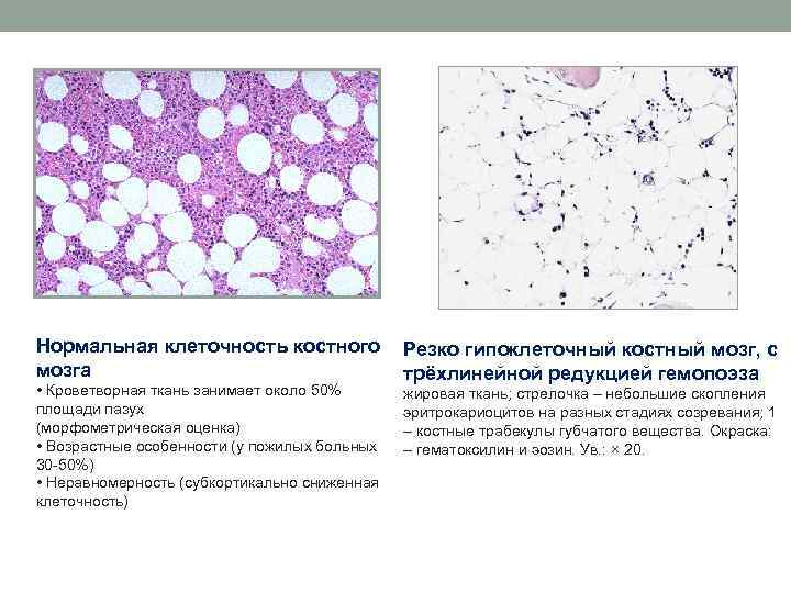 Нормальная клеточность костного Резко гипоклеточный костный мозг, с мозга трёхлинейной редукцией гемопоэза • Кроветворная