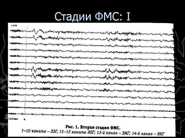 Стадии ФМС: I ► Стадия сна I = дремота = гипнотическое состояние ► Здесь