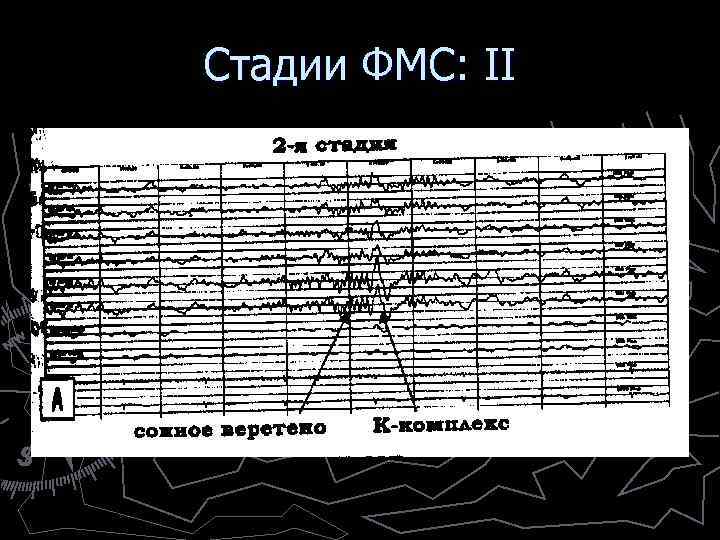 Стадии ФМС: II ► Стадия II = поверхностный сон ► Характеризуется появлением «сонных веретен»