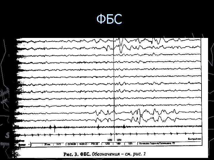  ФБС ► Характеризуется быстрыми движениями глаз (БДГ), потому его иногда называют REM-sleep (а