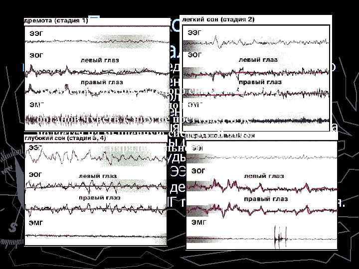 Парадоксальность “парадоксального” сна ► Для смены стадий медленного сна характерно постепенное увеличение амплитуды и