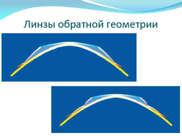 Линзы обратной геометрии 