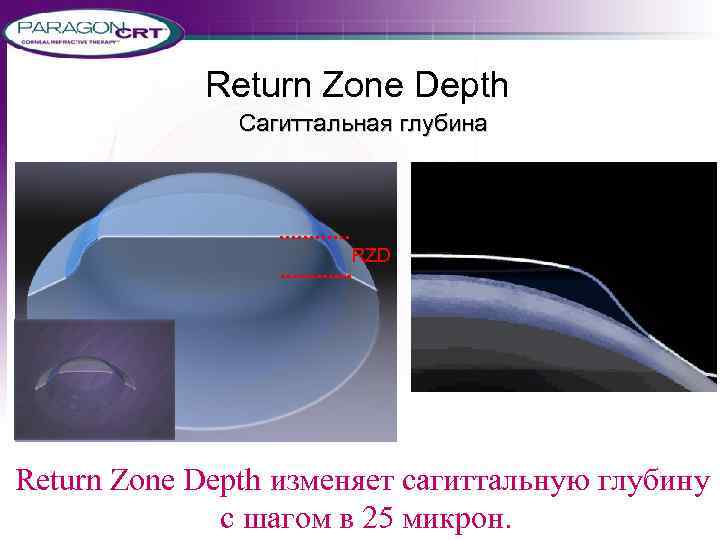 Return Zone Depth Сагиттальная глубина RZD Return Zone Depth изменяет сагиттальную глубину с шагом