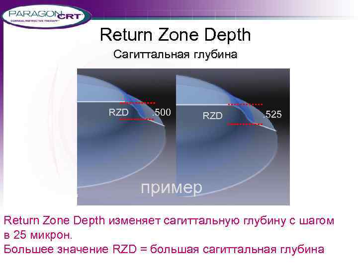 Return Zone Depth Сагиттальная глубина RZD . 500 RZD . 525 пример Return Zone