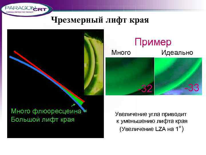 Чрезмерный лифт края Пример Много 10. 5 mm Много флюоресцеина = Большой лифт края