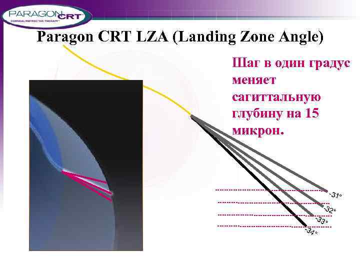 Paragon CRT LZA (Landing Zone Angle) Шаг в один градус меняет сагиттальную глубину на