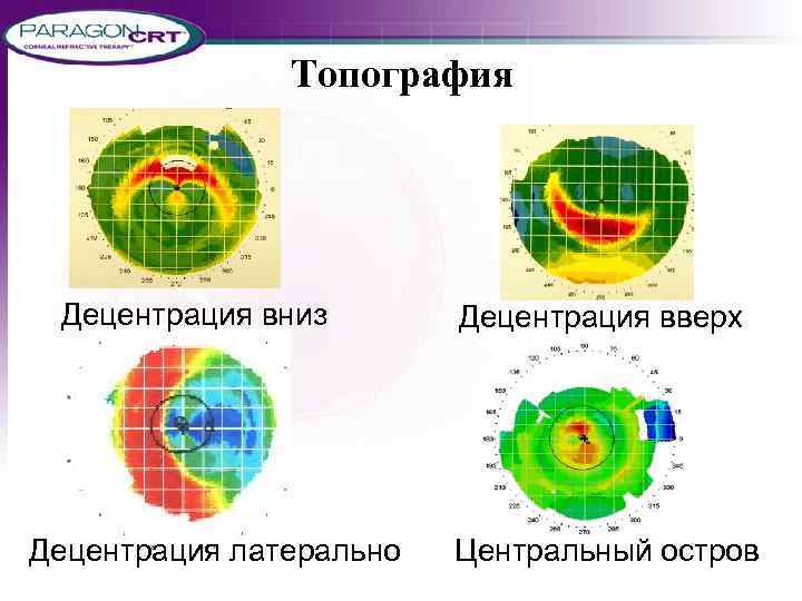 Топография Децентрация вниз Децентрация латерально Децентрация вверх Центральный остров 