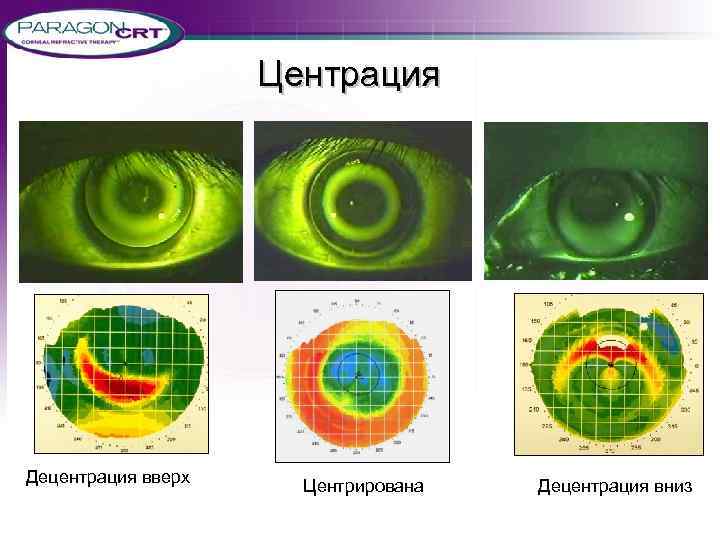 Центрация Децентрация вверх Центрирована Децентрация вниз 