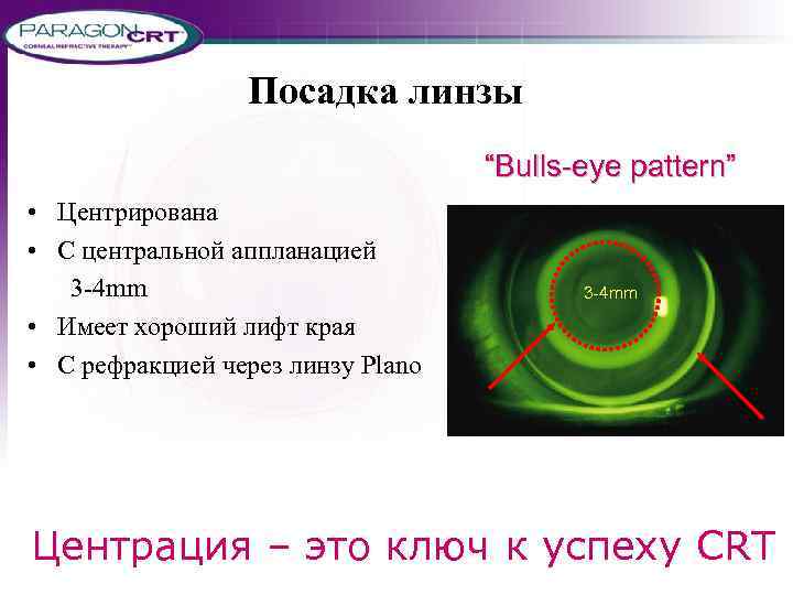 Посадка линзы “Bulls-eye pattern” • Центрирована • С центральной аппланацией 3 -4 mm •