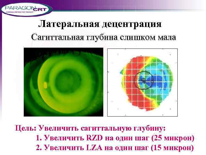 Латеральная децентрация Сагиттальная глубина слишком мала Цель: Увеличить сагиттальную глубину: 1. Увеличить RZD на