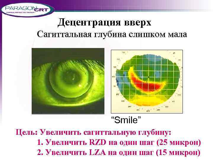 Децентрация вверх Сагиттальная глубина слишком мала “Smile” Цель: Увеличить сагиттальную глубину: 1. Увеличить RZD