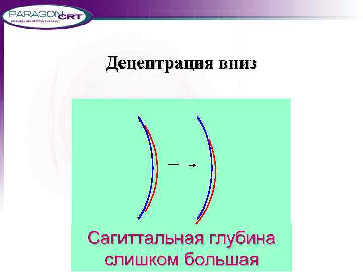 Децентрация вниз Сагиттальная глубина слишком большая 