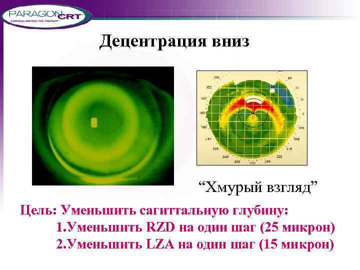 Децентрация вниз “Хмурый взгляд” Цель: Уменьшить сагиттальную глубину: 1. Уменьшить RZD на один шаг