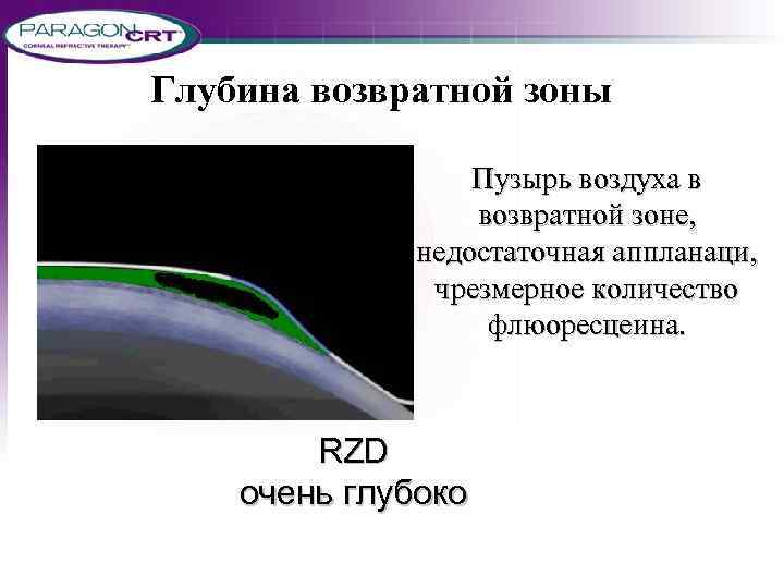 Глубина возвратной зоны Пузырь воздуха в возвратной зоне, недостаточная аппланаци, чрезмерное количество флюоресцеина. RZD