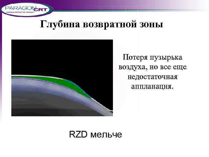 Глубина возвратной зоны Потеря пузырька воздуха, но все еще недостаточная аппланация. RZD мельче 