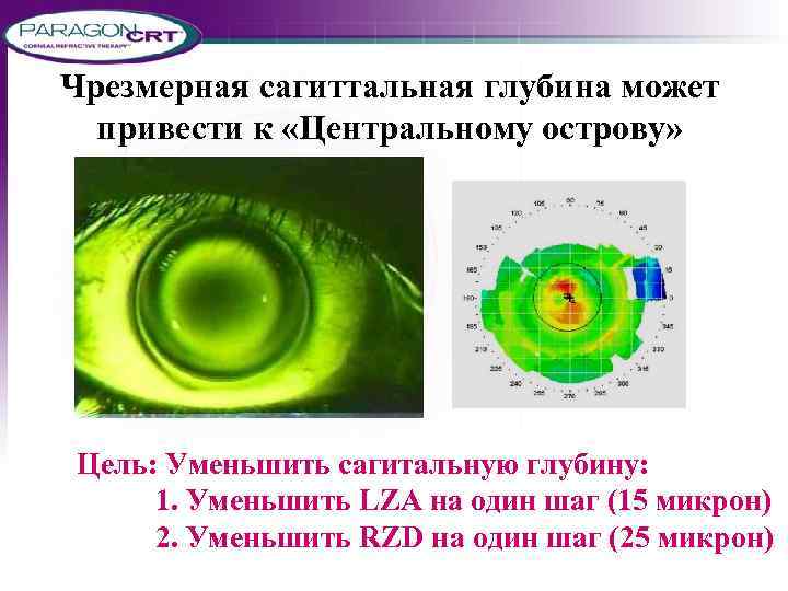 Чрезмерная сагиттальная глубина может привести к «Центральному острову» Цель: Уменьшить сагитальную глубину: 1. Уменьшить